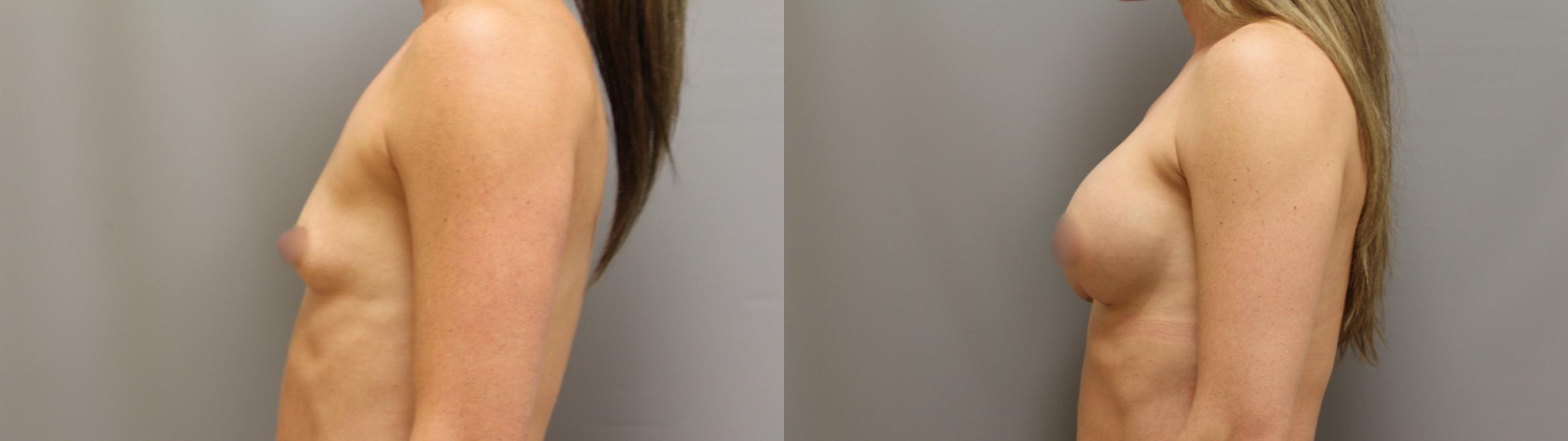 Augmentation, Left Side Photo, Calgary Alberta, Demsey Plastic Surgery