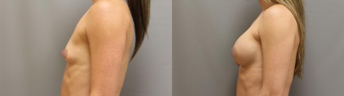 Augmentation, Left Side Photo, Calgary Alberta, Demsey Plastic Surgery