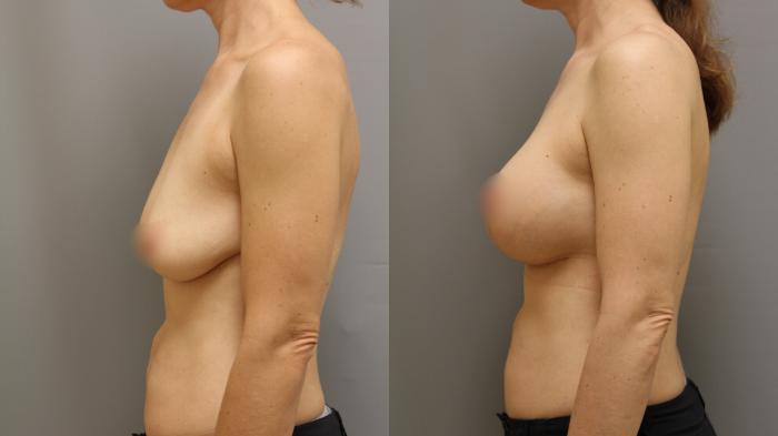 Augmentation, Left Side Photo, Calgary Alberta, Demsey Plastic Surgery