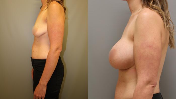 Augmentation, Left Side Photo, Calgary Alberta, Demsey Plastic Surgery