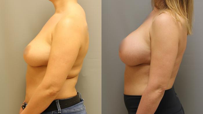 Augmentation, Before and After Photo, Calgary Alberta, Demsey Plastic Surgery
