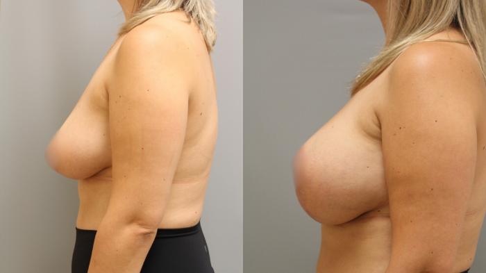 Augmentation, Left Side Photo, Calgary Alberta, Demsey Plastic Surgery
