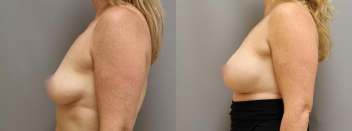 Augmentation, Left Side Photo, Calgary Alberta, Demsey Plastic Surgery