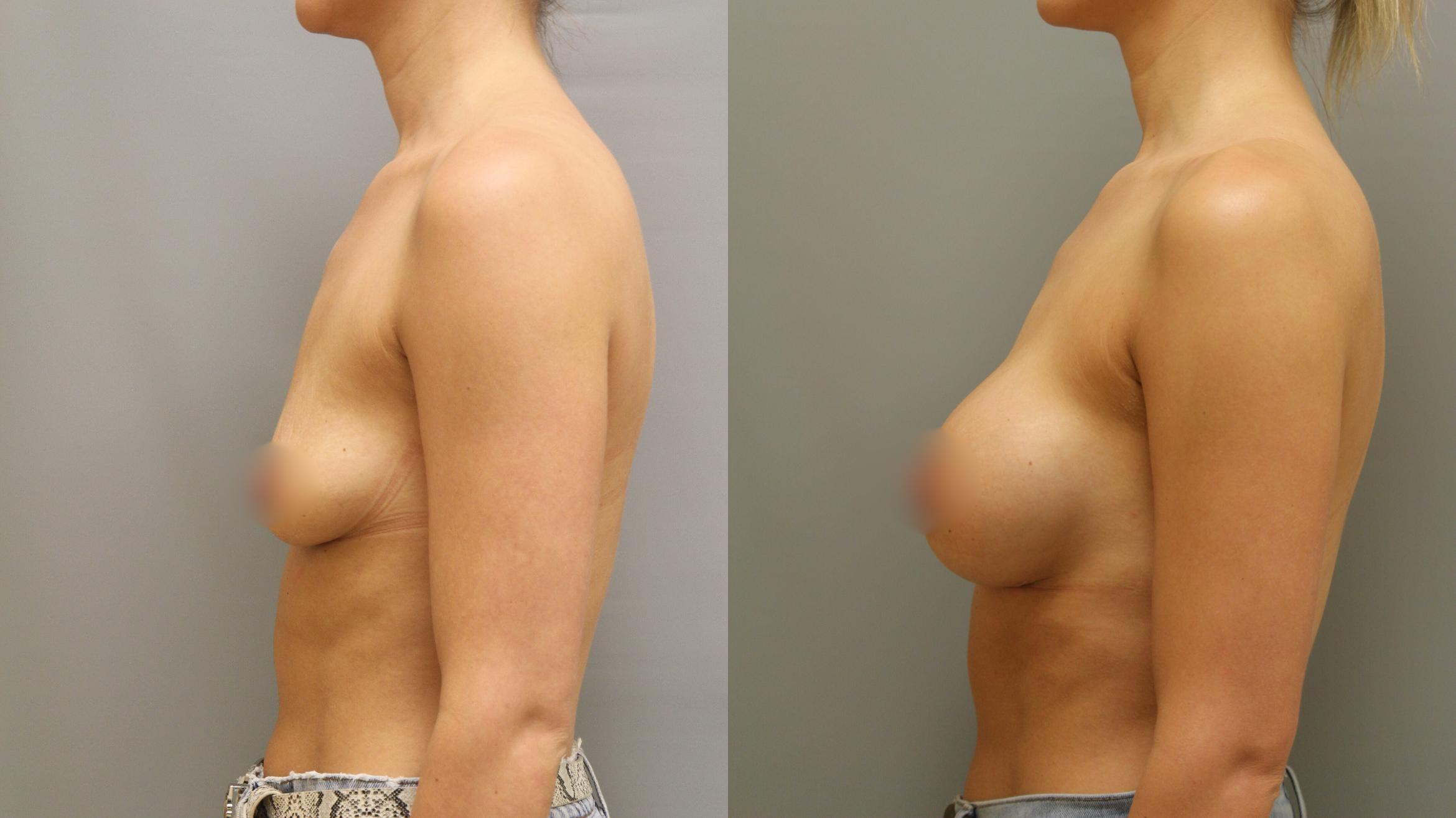 Augmentation, Left Side Photo, Calgary Alberta, Demsey Plastic Surgery