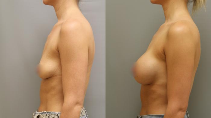 Augmentation, Left Side Photo, Calgary Alberta, Demsey Plastic Surgery