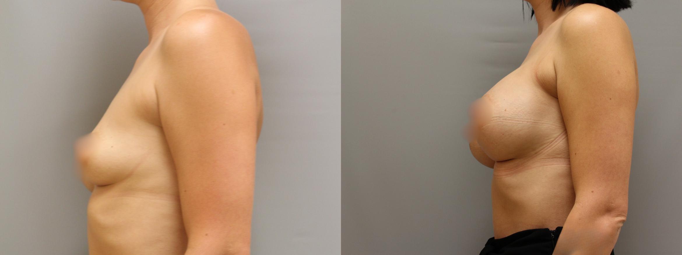 Augmentation, Left Side Photo, Calgary Alberta, Demsey Plastic Surgery