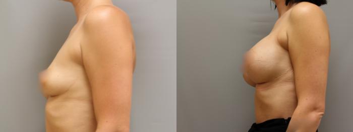 Augmentation, Left Side Photo, Calgary Alberta, Demsey Plastic Surgery