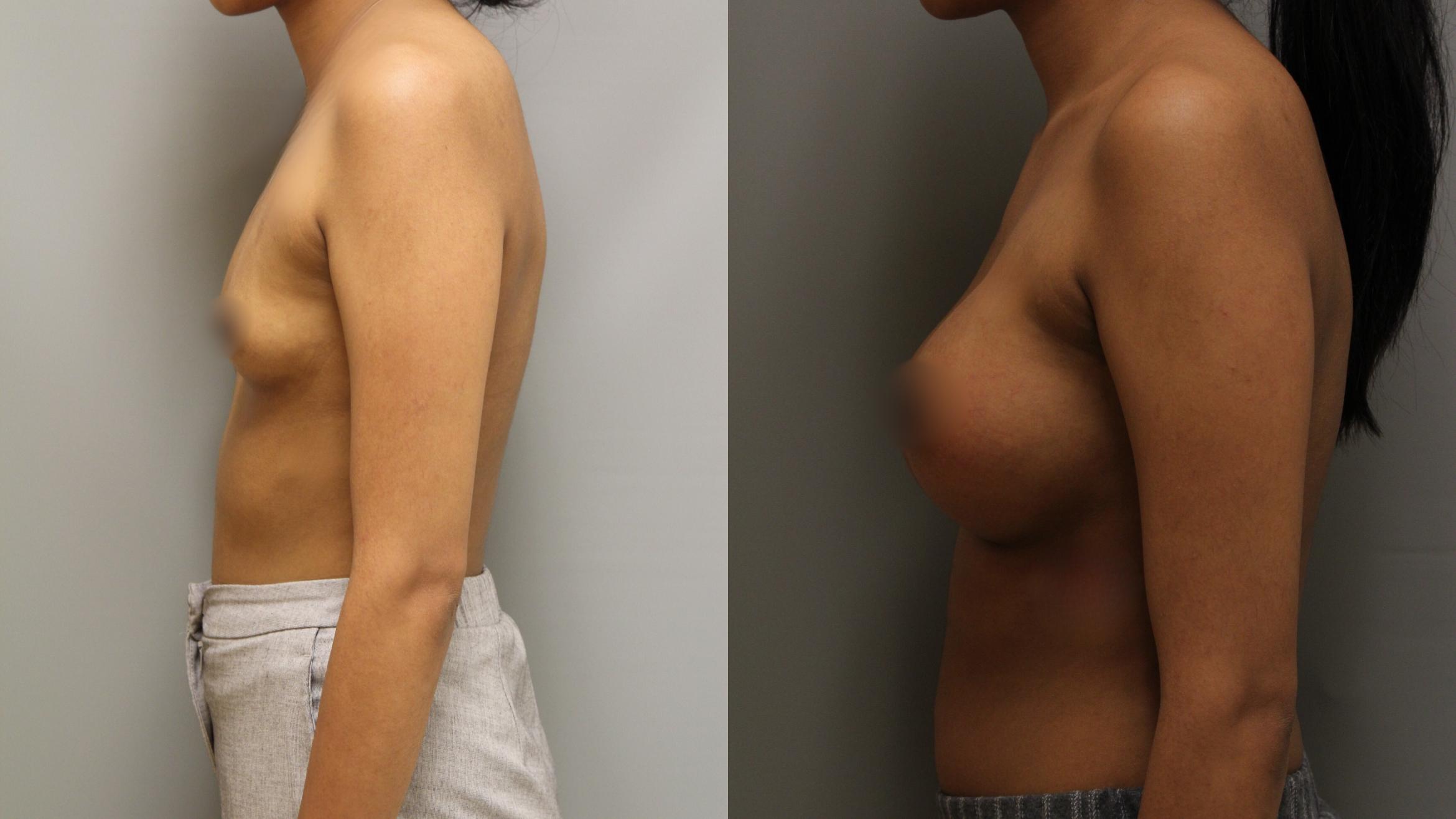 Augmentation, Left Side Photo, Calgary Alberta, Demsey Plastic Surgery