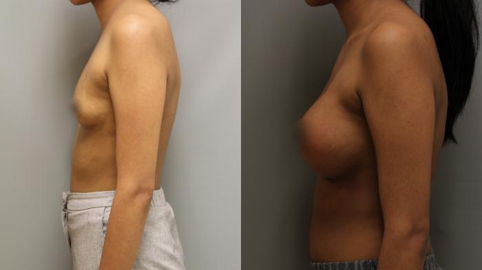 Augmentation, Left Side Photo, Calgary Alberta, Demsey Plastic Surgery