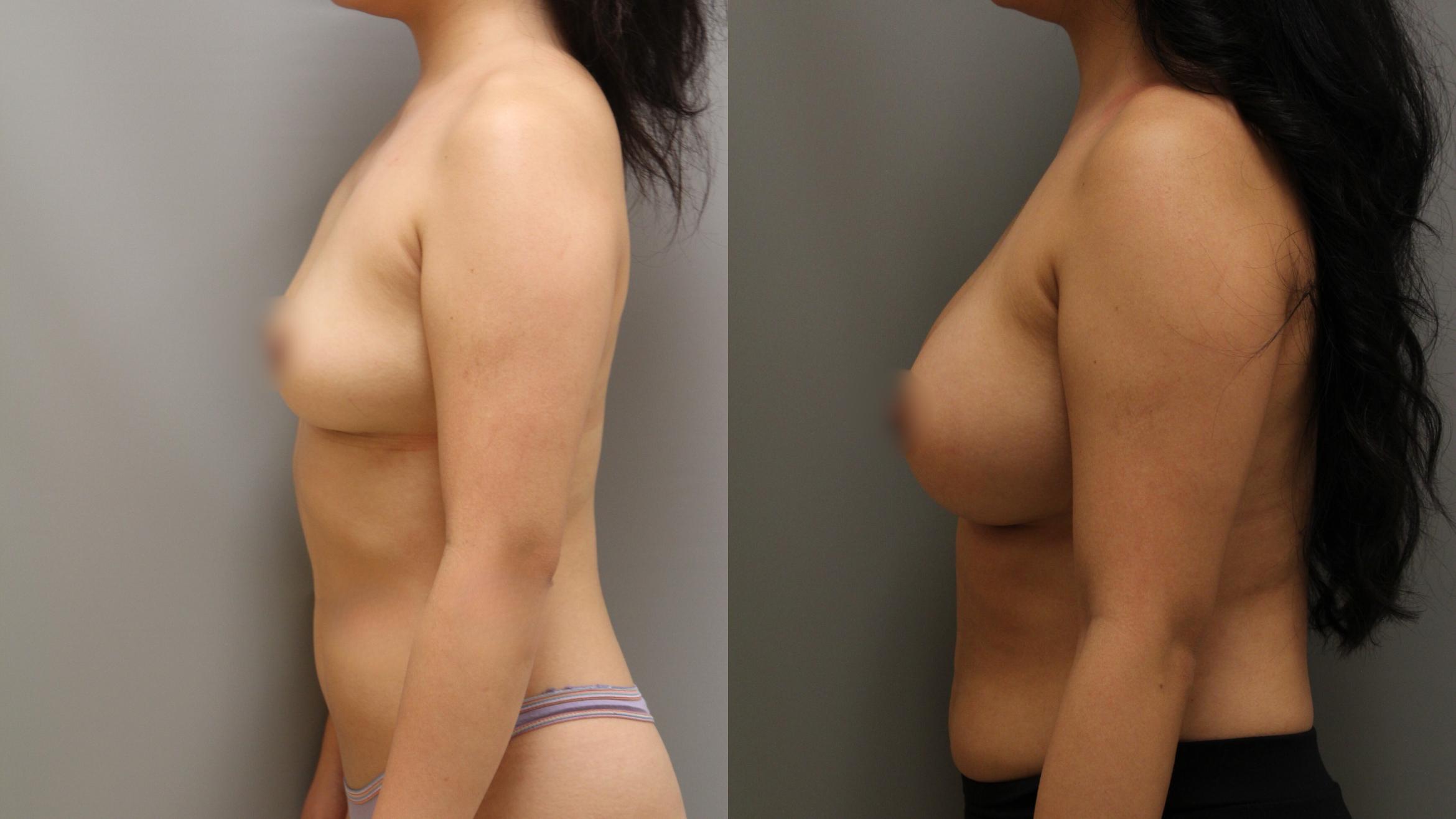 Augmentation, Left Side Photo, Calgary Alberta, Demsey Plastic Surgery