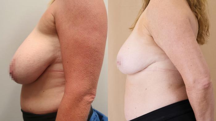 Before & After Breast Reduction Case 23 Left Side View in Calgary, Alberta
