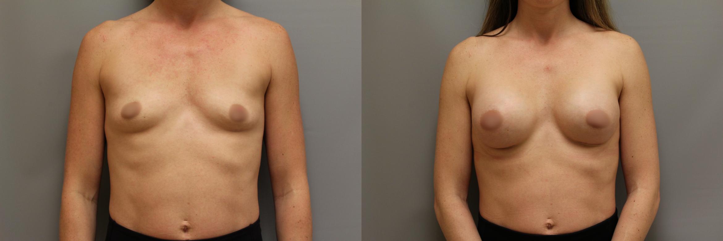 Augmentation, Front Photo, Calgary Alberta, Demsey Plastic Surgery 