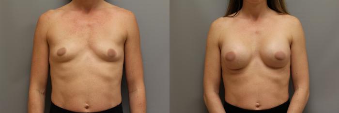 Augmentation, Front Photo, Calgary Alberta, Demsey Plastic Surgery 
