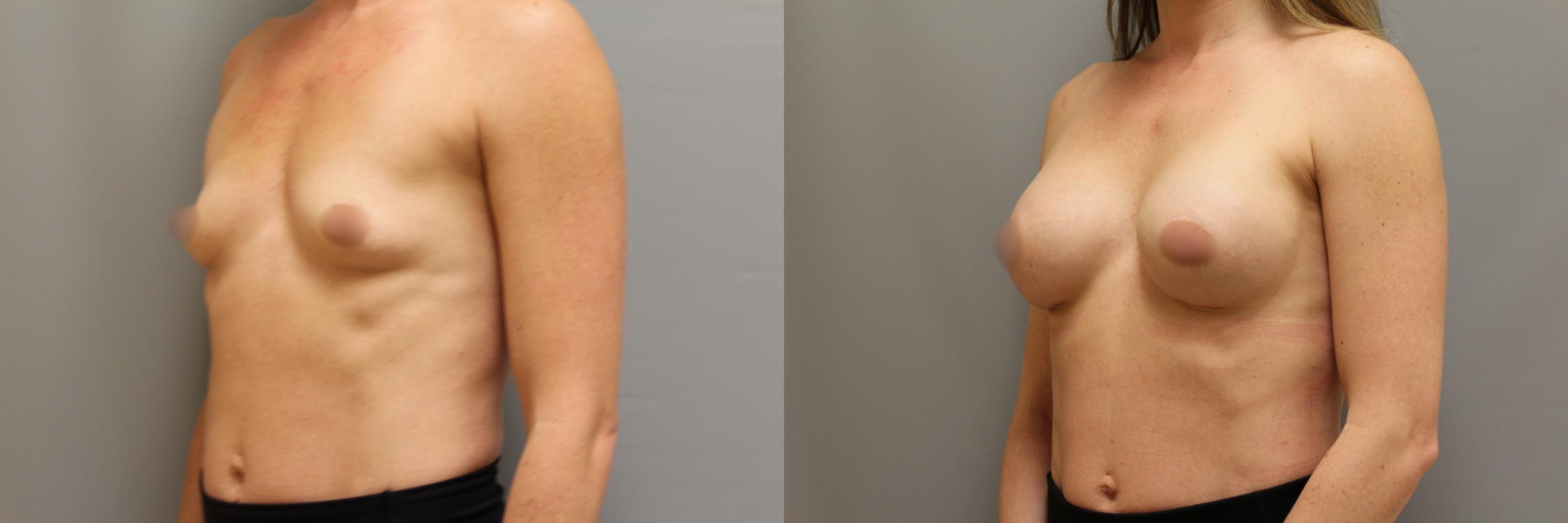 Augmentation, Left Oblique Photo, Calgary Alberta, Demsey Plastic Surgery 