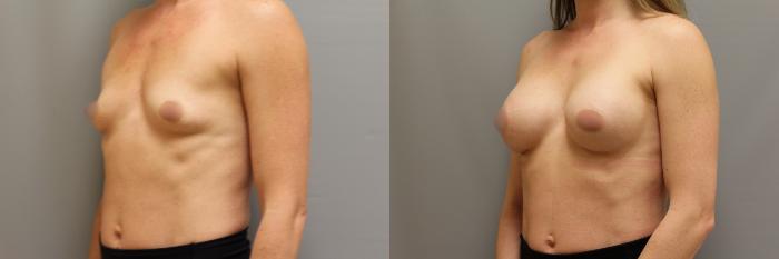 Augmentation, Left Oblique Photo, Calgary Alberta, Demsey Plastic Surgery 
