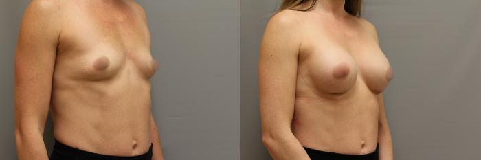 Augmentation, Right Oblique Photo, Calgary Alberta, Demsey Plastic Surgery 