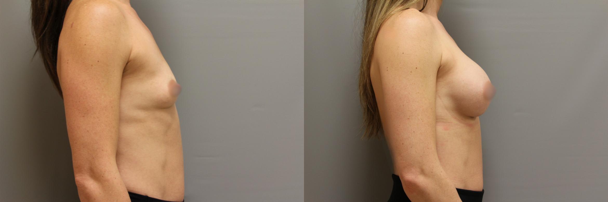 Augmentation, Right Side Photo, Calgary Alberta, Demsey Plastic Surgery 