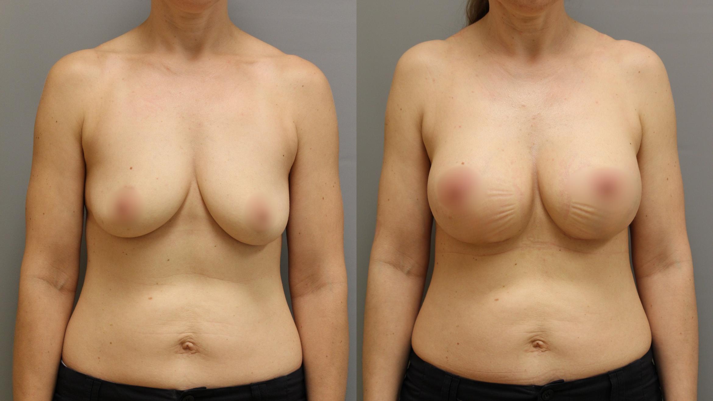 Augmentation, Front Photo, Calgary Alberta, Demsey Plastic Surgery 