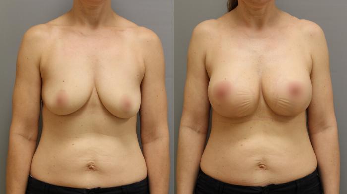 Augmentation, Front Photo, Calgary Alberta, Demsey Plastic Surgery 