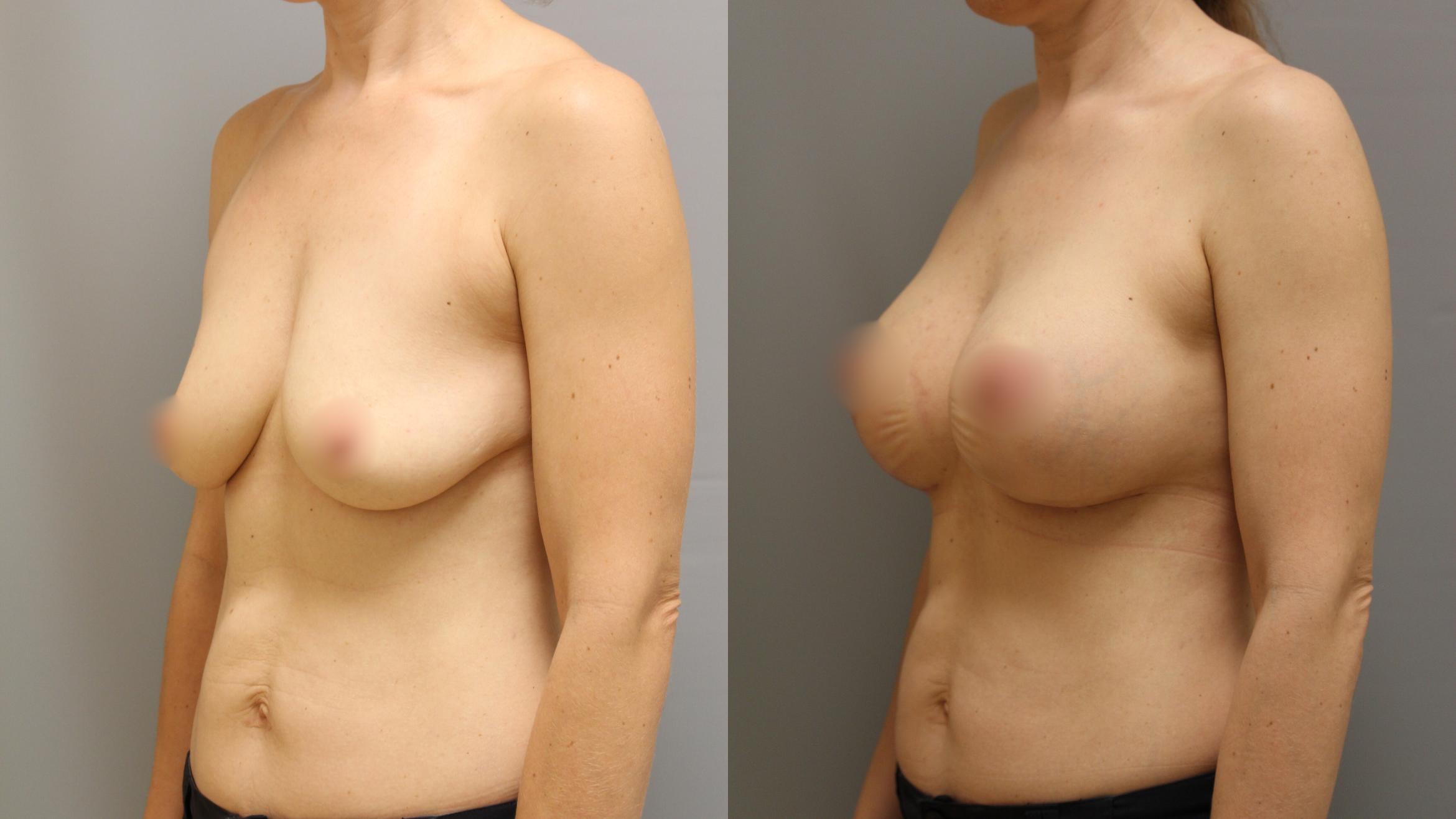Augmentation, Left Oblique Photo, Calgary Alberta, Demsey Plastic Surgery 