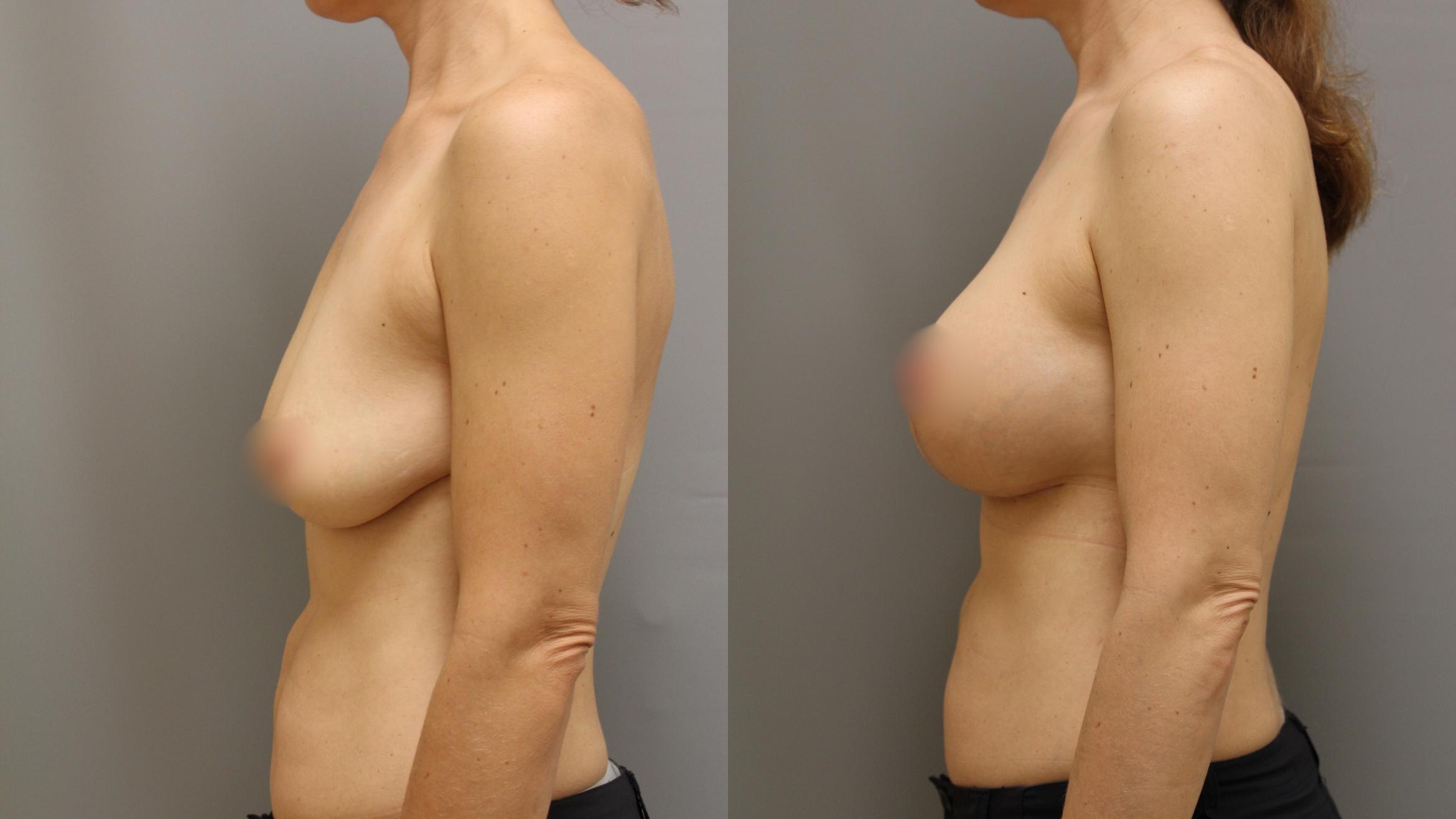 Augmentation, Left Side Photo, Calgary Alberta, Demsey Plastic Surgery 