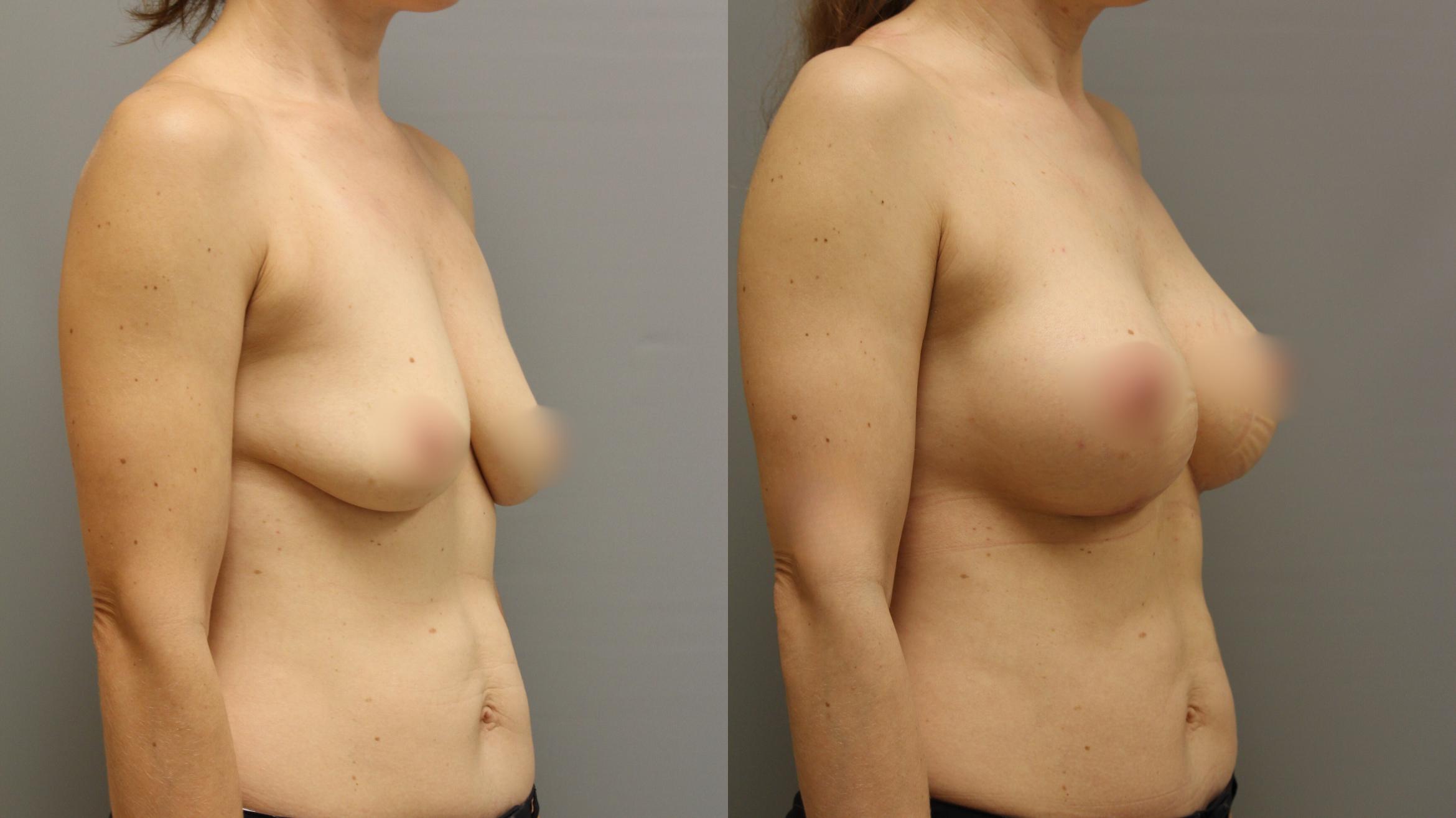 Augmentation, Right Oblique Photo, Calgary Alberta, Demsey Plastic Surgery 