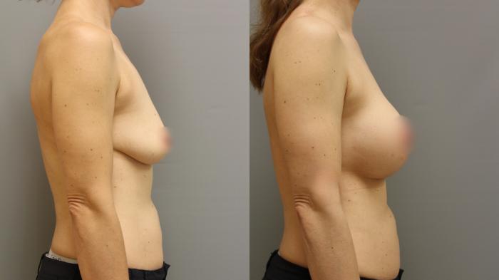 Augmentation, Right Side Photo, Calgary Alberta, Demsey Plastic Surgery 