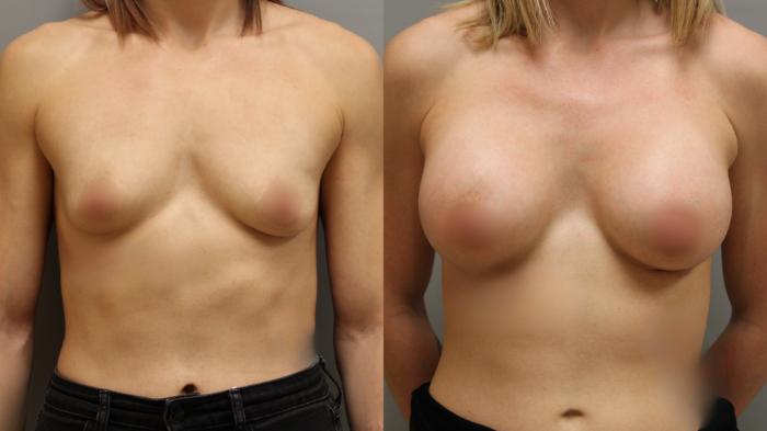 Augmentation, Front Photo, Calgary Alberta, Demsey Plastic Surgery 