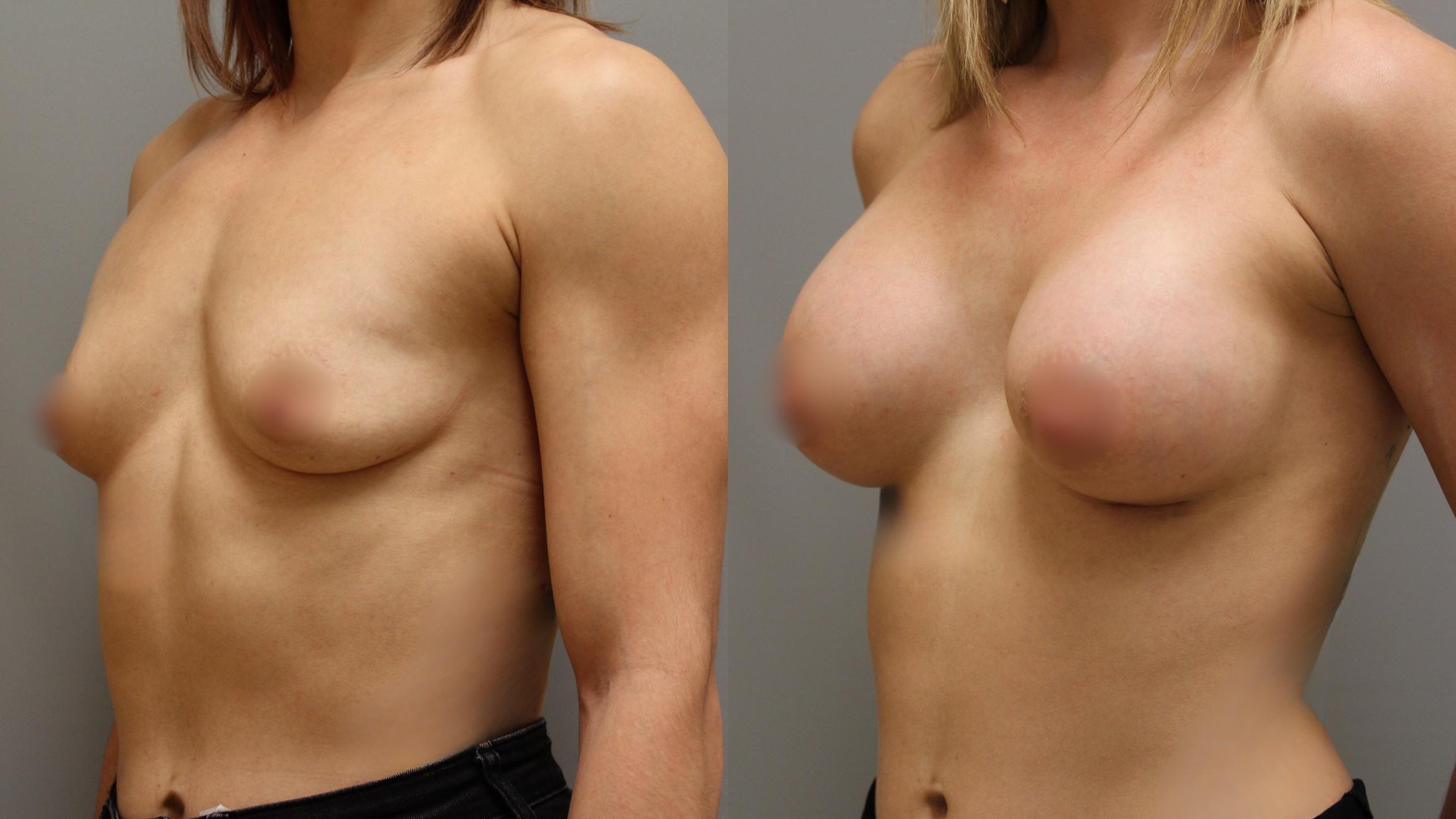 Augmentation, Left Oblique Photo, Calgary Alberta, Demsey Plastic Surgery 
