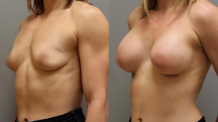 Augmentation, Left Oblique Photo, Calgary Alberta, Demsey Plastic Surgery 