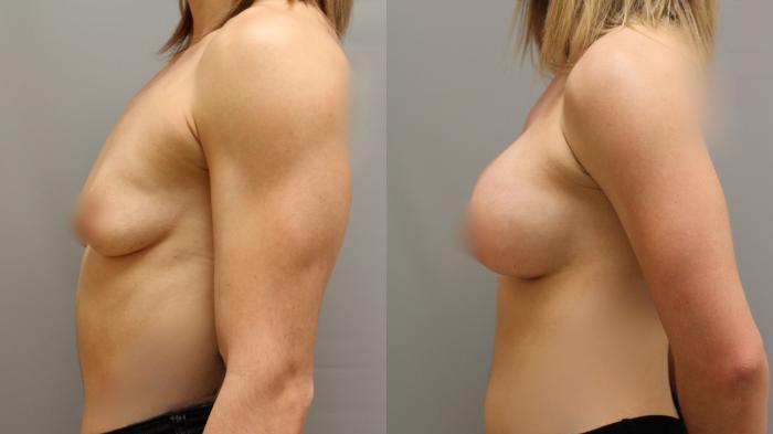 Augmentation, Left Side Photo, Calgary Alberta, Demsey Plastic Surgery 