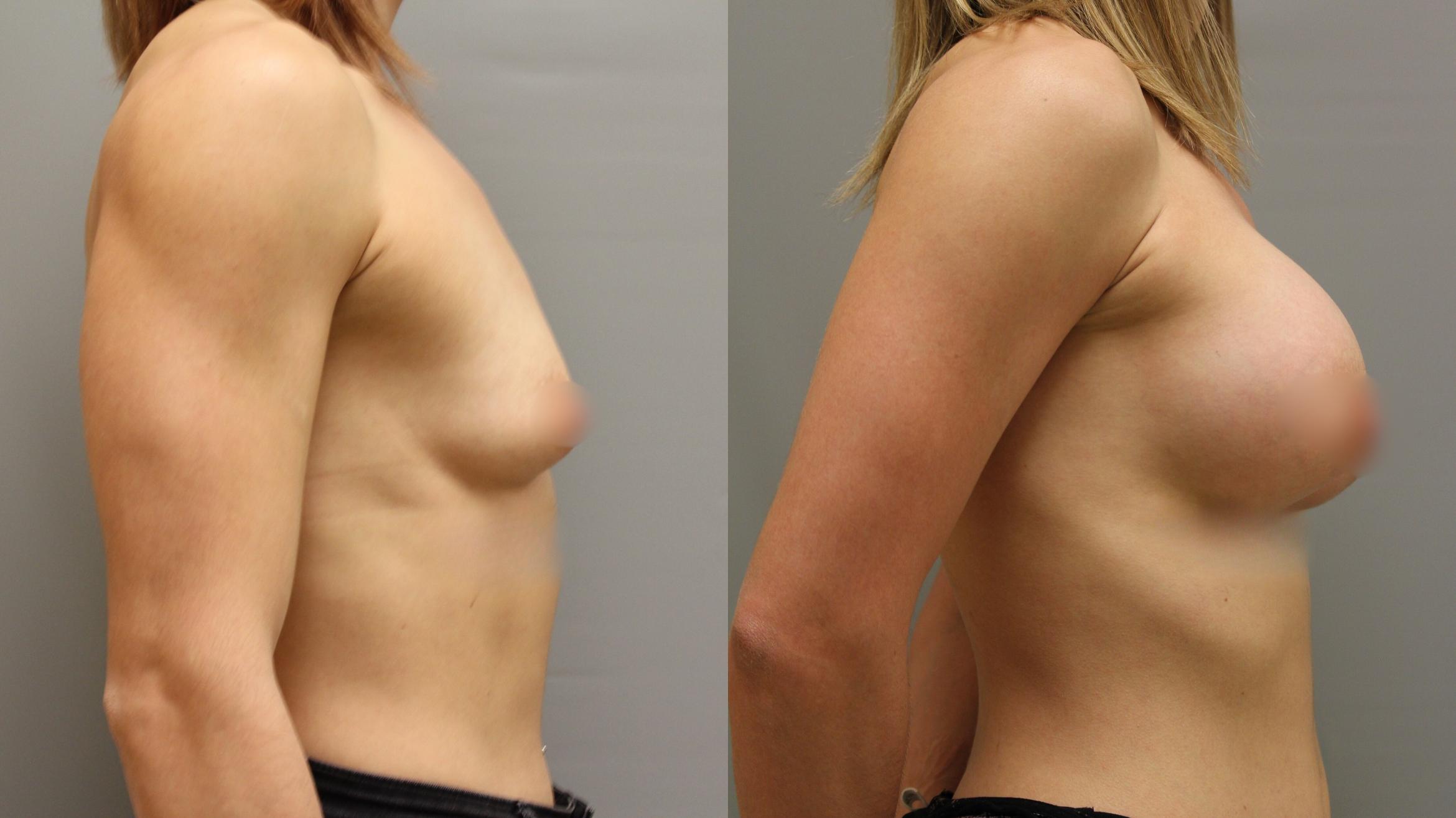 Augmentation, Right Side Photo, Calgary Alberta, Demsey Plastic Surgery 