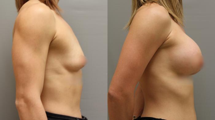 Augmentation, Right Side Photo, Calgary Alberta, Demsey Plastic Surgery 