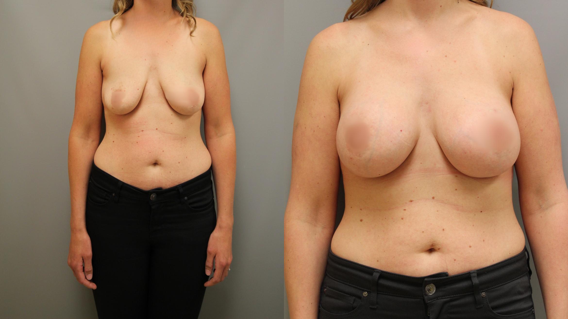 Augmentation, Front View Photo, Calgary Alberta, Demsey Plastic Surgery 