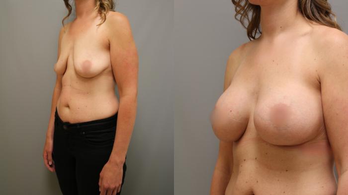 Augmentation, Left Oblique Photo, Calgary Alberta, Demsey Plastic Surgery 