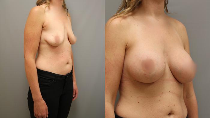 Augmentation, Right Oblique Photo, Calgary Alberta, Demsey Plastic Surgery 