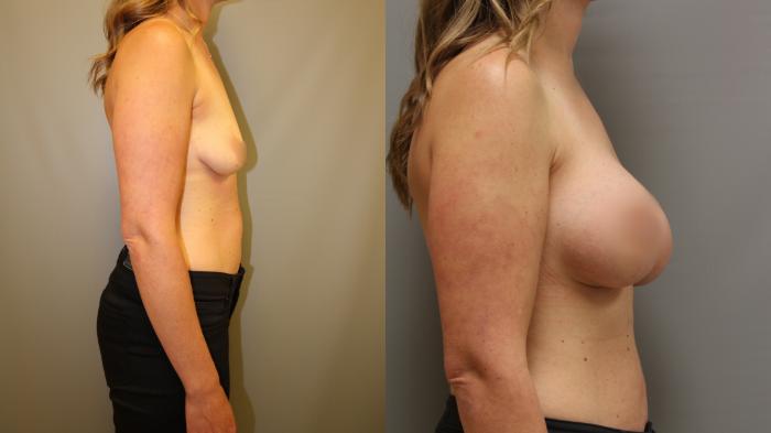 Augmentation, Right Side Photo, Calgary Alberta, Demsey Plastic Surgery 