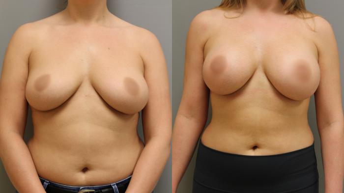 Augmentation, Before and After Photo, Calgary Alberta, Demsey Plastic Surgery 