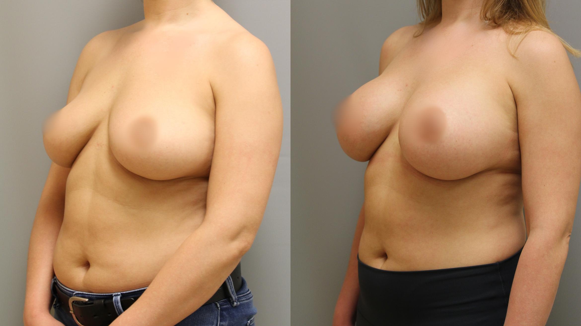 Augmentation, Before and After Photo, Calgary Alberta, Demsey Plastic Surgery 