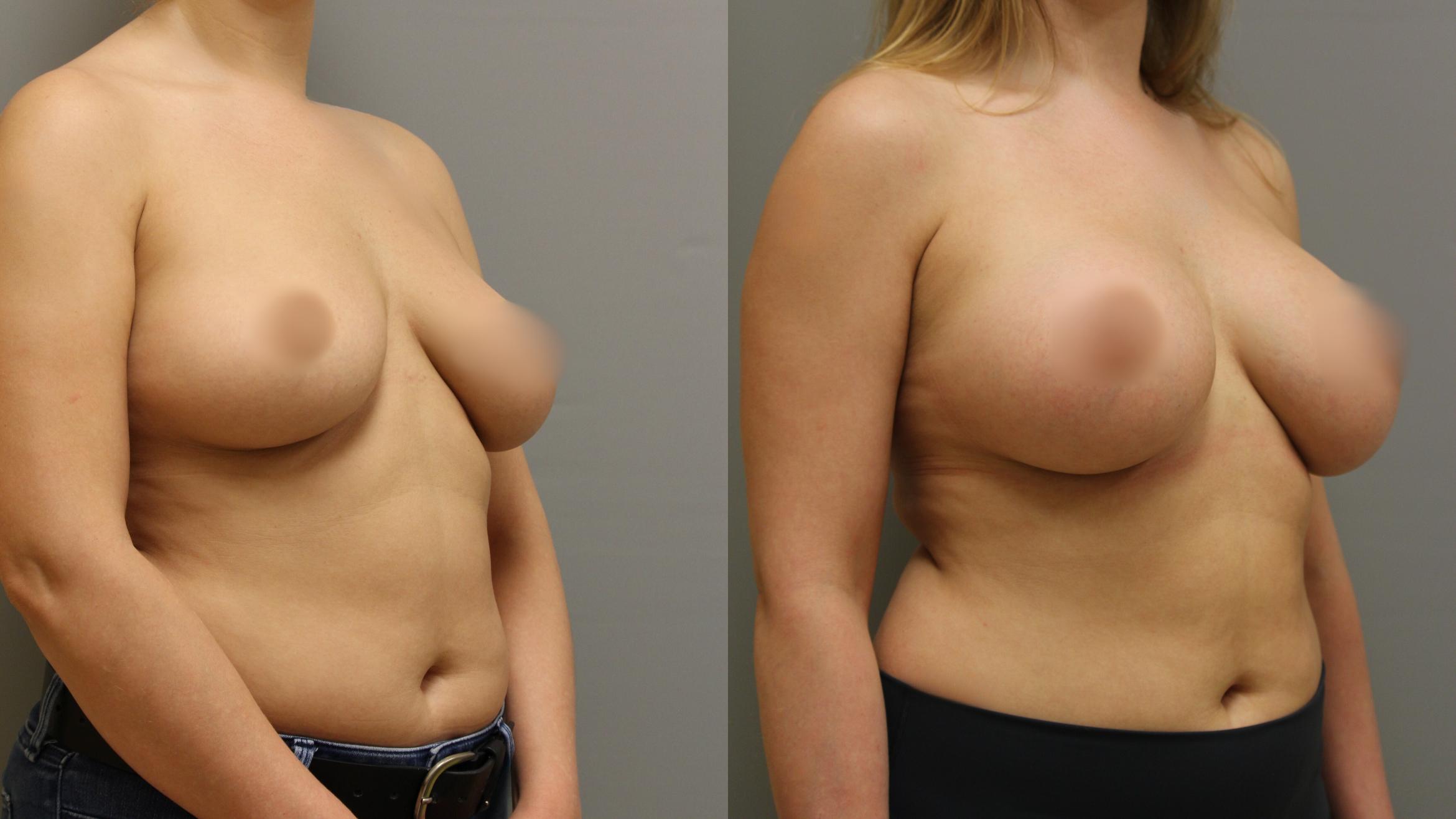 Augmentation, Before and After Photo, Calgary Alberta, Demsey Plastic Surgery 