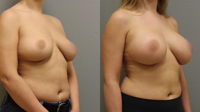 Augmentation, Before and After Photo, Calgary Alberta, Demsey Plastic Surgery 