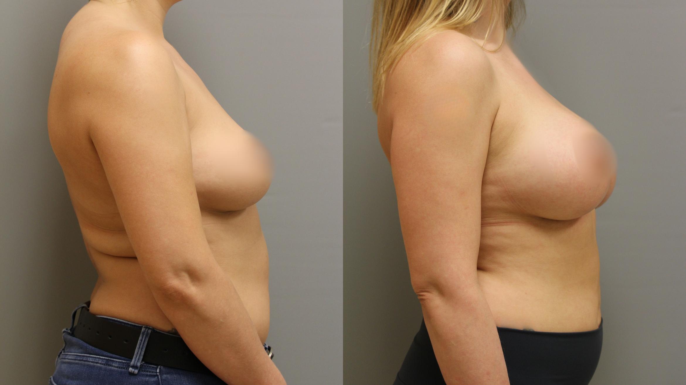Augmentation, Before and After Photo, Calgary Alberta, Demsey Plastic Surgery 