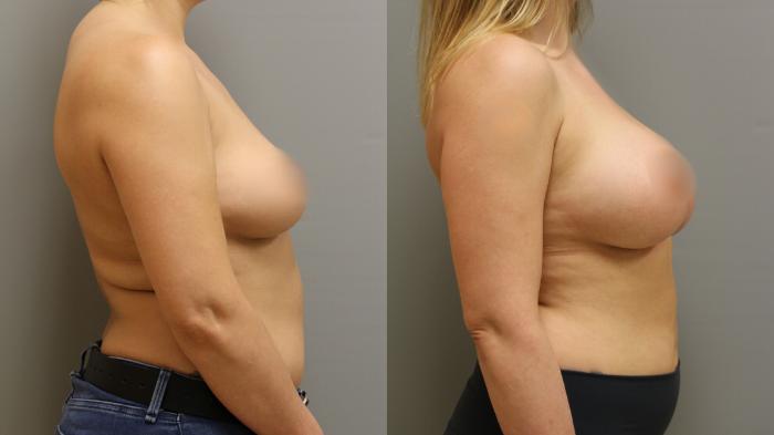Augmentation, Before and After Photo, Calgary Alberta, Demsey Plastic Surgery 