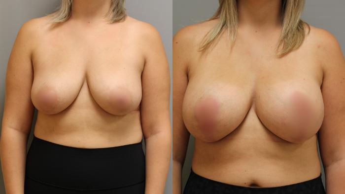 Augmentation, Front Photo, Calgary Alberta, Demsey Plastic Surgery 