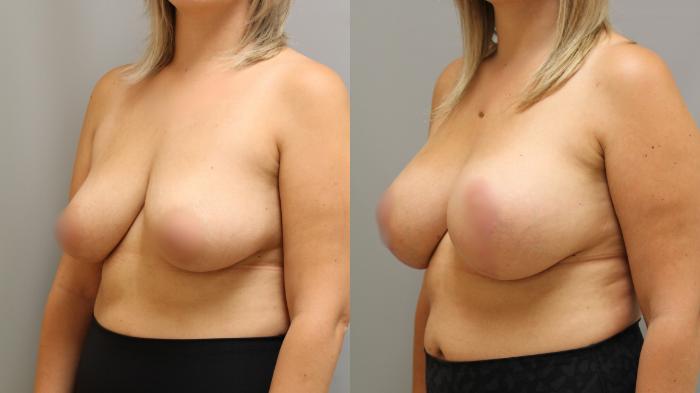 Augmentation, Left Oblique Photo, Calgary Alberta, Demsey Plastic Surgery 