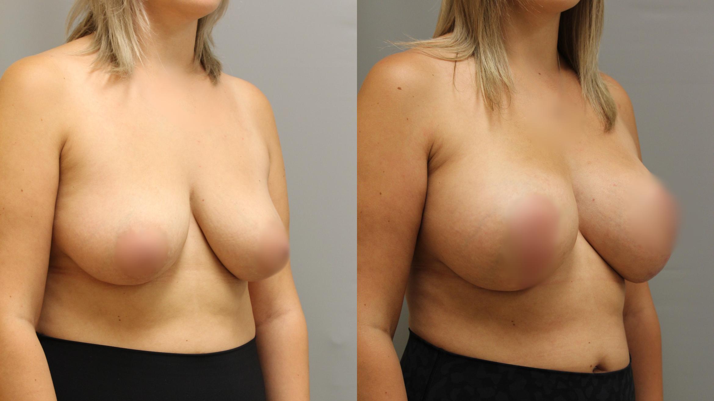 Augmentation, Right Oblique Photo, Calgary Alberta, Demsey Plastic Surgery 