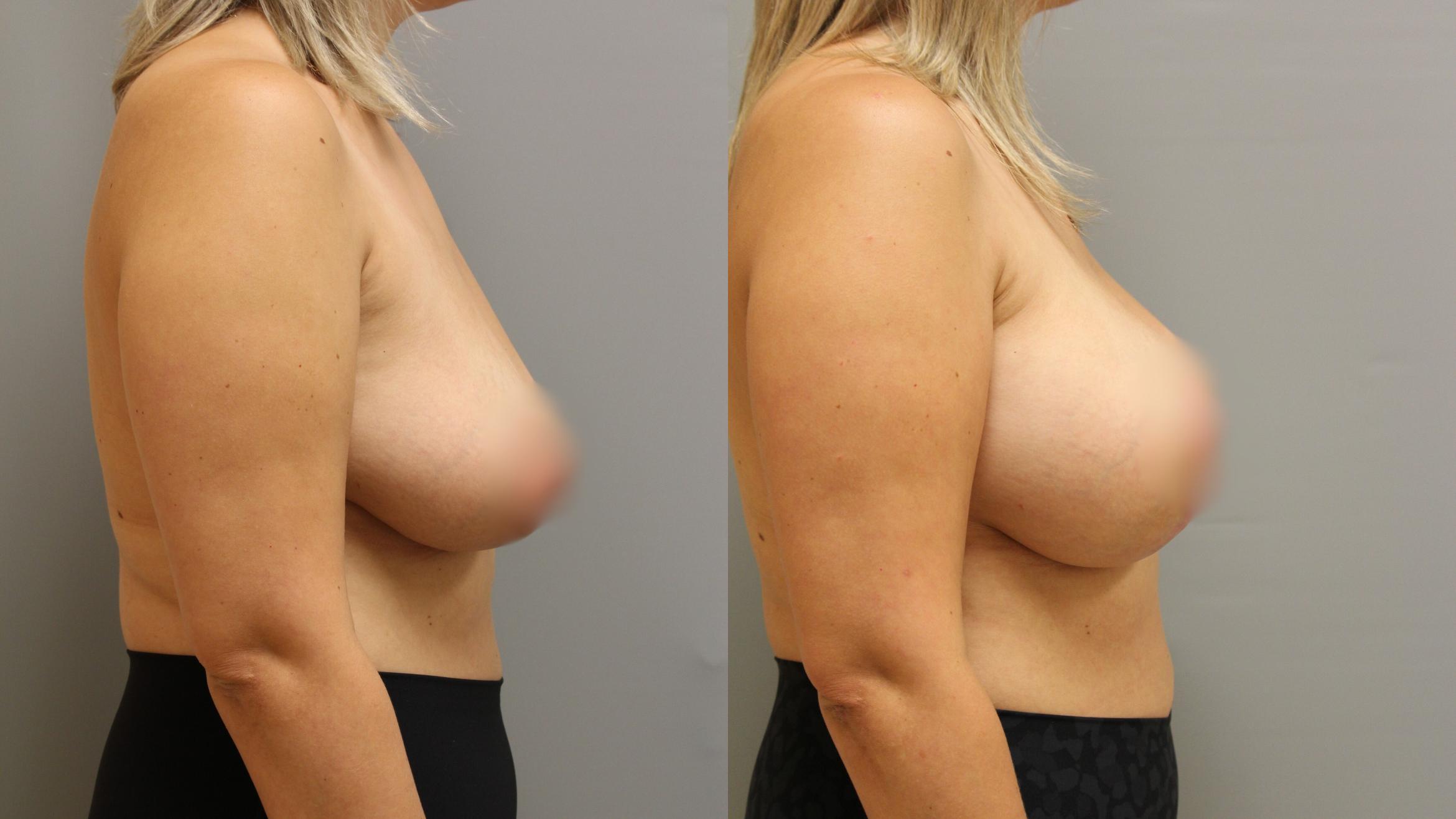 Augmentation, Right Side Photo, Calgary Alberta, Demsey Plastic Surgery 