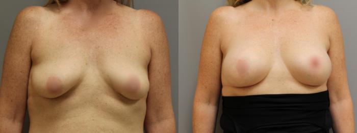 Augmentation, Front Photo, Calgary Alberta, Demsey Plastic Surgery 