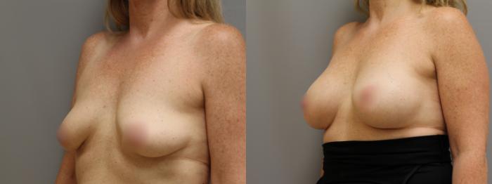 Augmentation, Left Oblique Photo, Calgary Alberta, Demsey Plastic Surgery 