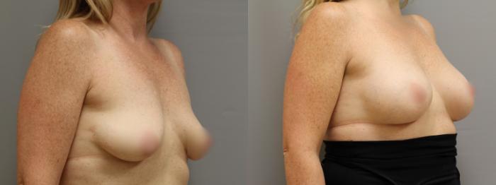 Augmentation, Right Oblique Photo, Calgary Alberta, Demsey Plastic Surgery 